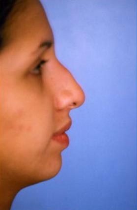 Rhinoplasty Before & After Patient #4789