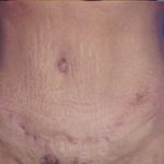 Tummy Tuck Before & After Patient #4855