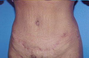 Tummy Tuck Before & After Patient #4855