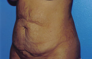 Tummy Tuck Before & After Patient #4855