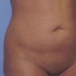 Liposuction Before & After Patient #4836