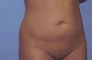 Liposuction Before & After Patient #4836