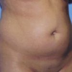 Liposuction Before & After Patient #4836