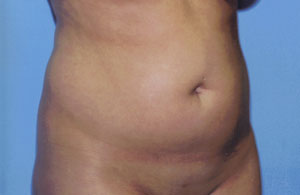 Liposuction Before & After Patient #4836