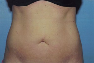 Liposuction Before & After Patient #4843