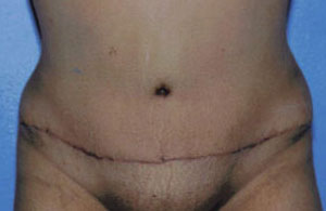 Tummy Tuck Before & After Patient #4862