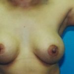 Breast Augmentation Before & After Patient #4927