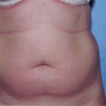 Liposuction Before & After Patient #4843