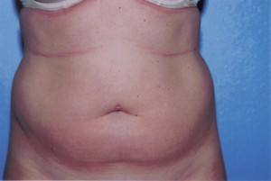 Liposuction Before & After Patient #4843