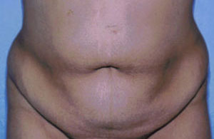 Tummy Tuck Before & After Patient #4862