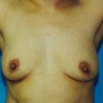Breast Augmentation Before & After Patient #4927