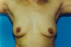 Breast Augmentation Before & After Patient #4927