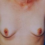 Breast Lift Before & After Patient #5021