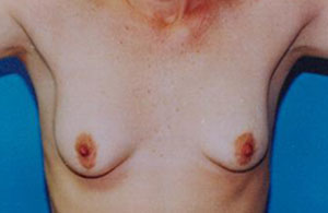 Breast Lift Before & After Patient #5021