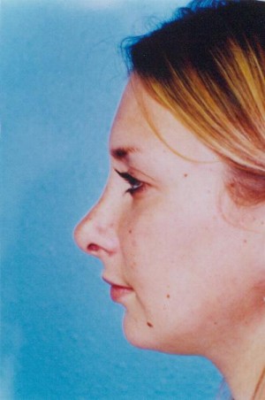 Rhinoplasty Before & After Patient #4796