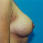 Breast Augmentation Before & After Patient #4927