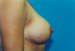 Breast Augmentation Before & After Patient #4927