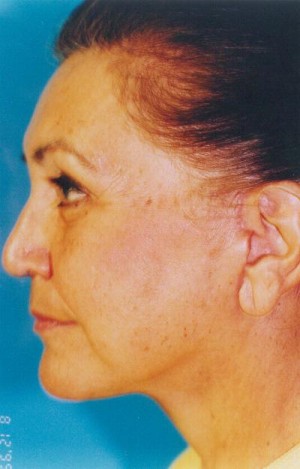 Facelift / Blepharoplasty Before & After Patient #4759