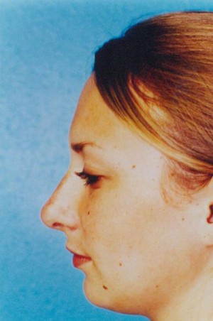 Rhinoplasty Before & After Patient #4796