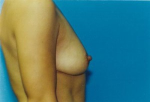 Breast Augmentation Before & After Patient #4927