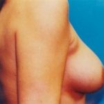 Breast Lift Before & After Patient #5021