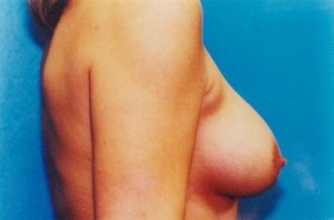Breast Lift Before & After Patient #5021