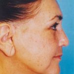 Facelift / Blepharoplasty Before & After Patient #4759