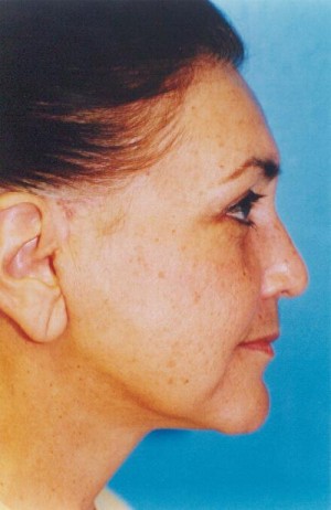 Facelift / Blepharoplasty Before & After Patient #4759