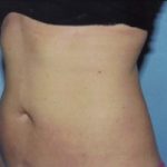 Liposuction Before & After Patient #4843