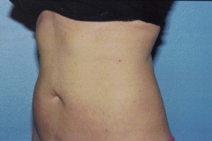 Liposuction Before & After Patient #4843