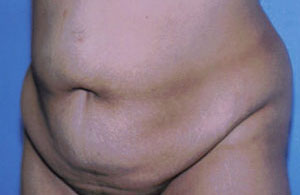 Tummy Tuck Before & After Patient #4862