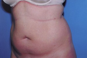 Liposuction Before & After Patient #4843