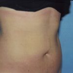 Liposuction Before & After Patient #4843