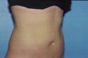 Liposuction Before & After Patient #4843