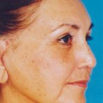 Facelift / Blepharoplasty Before & After Patient #4759