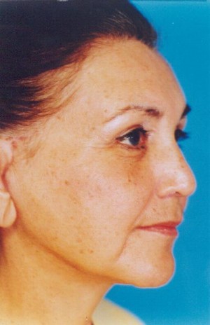 Facelift / Blepharoplasty Before & After Patient #4759