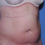 Liposuction Before & After Patient #4843