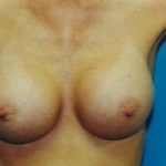 Breast Augmentation Before & After Patient #4934