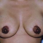 Breast Lift Before & After Patient #5026