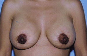 Breast Lift Before & After Patient #5026