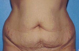 Tummy Tuck Before & After Patient #4869