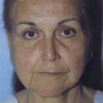 Facelift / Blepharoplasty Before & After Patient #4768