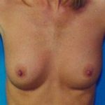 Breast Augmentation Before & After Patient #4934