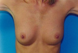 Breast Augmentation Before & After Patient #4934