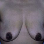 Breast Lift Before & After Patient #5026