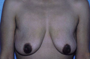 Breast Lift Before & After Patient #5026