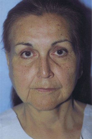 Facelift / Blepharoplasty Before & After Patient #4768