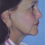 Facelift / Blepharoplasty Before & After Patient #4768