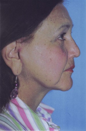 Facelift / Blepharoplasty Before & After Patient #4768