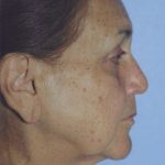 Facelift / Blepharoplasty Before & After Patient #4768